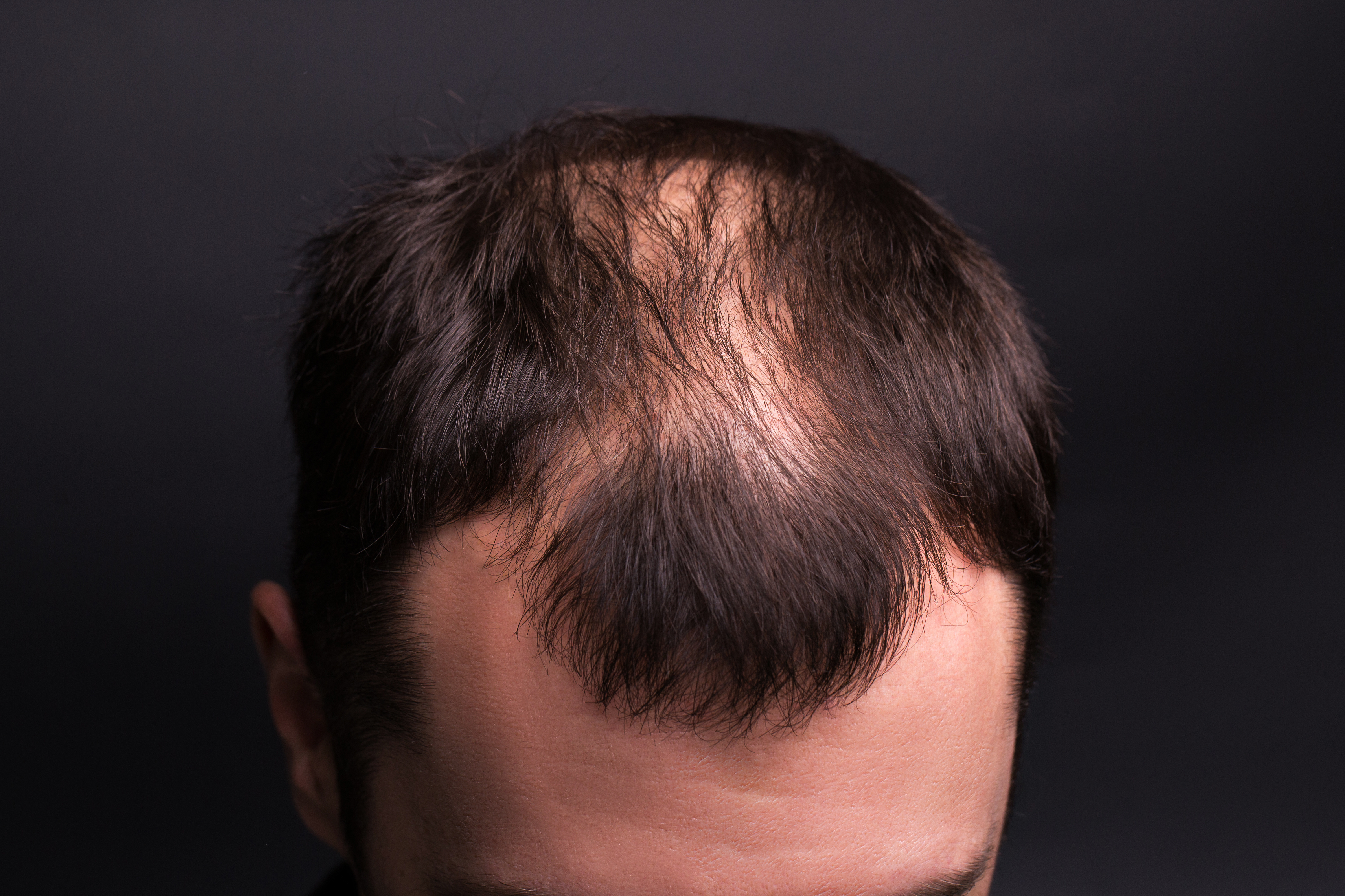 Balding Men's Hair Loss Treatment In Honolulu & New York
